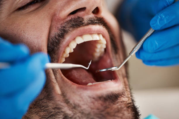 Best Emergency Wisdom Teeth Removal in Patterson, CA